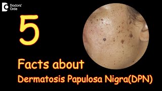 5 Facts about Dermatosis Papulosa Nigra  What are DPN’s  Dr Divya SharmaDoctors Circle [upl. by Ronen]