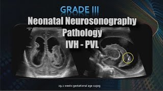 Neonatal Neurosonography  Pathology  IVH  PVL [upl. by Atalayah947]