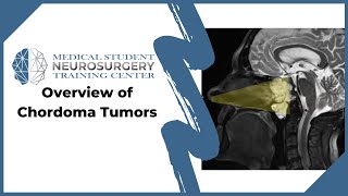 Overview of Chordoma Tumors [upl. by Freida]