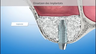 Sinuslift  Sinusbodenelevation 3DAnimation Zahnmedizin [upl. by Lekym140]