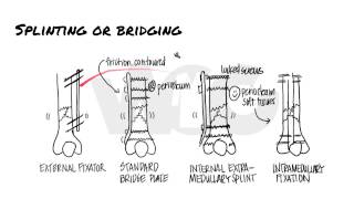 Principles of Fracture Fixation  Orthopedic Basics [upl. by Hannon426]