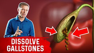 Do This to Help Dissolve Gallstones [upl. by Laurens]