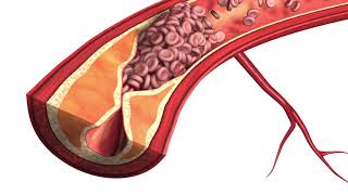 Atherosclerosis  Plaque Animation Model [upl. by Forlini74]