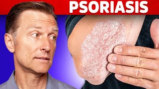 Psoriasis Treatment – The Best 3 Remedies for Psoriasis – DrBerg [upl. by Nwahsaj]