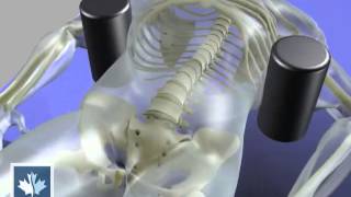 Sciatica  Spinal Decompression  Back Clinics of Canada [upl. by Joshia685]