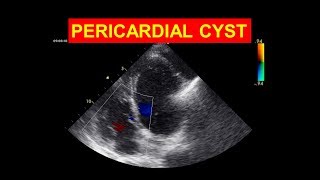 Pericardial Cyst  A rare echo finding [upl. by Nitsrek]