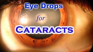 Lanosterol Eye Drops can cure Cataract without Surgery [upl. by Wendelin]