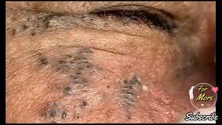 Dr Pop  Deep Blackheads in old Skin removing amp treatment 2020 Part 5 [upl. by Osnofla]