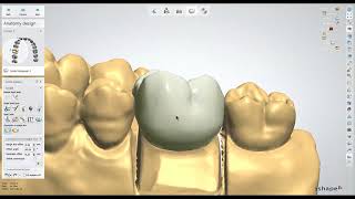 Dental Lab Life Designing a Crown in 3Shape [upl. by Pascasia]