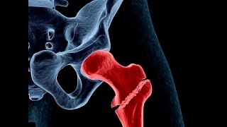 Treating Osteoporosis or Low Bone Density [upl. by Telocin]