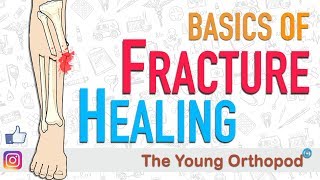 Fracture Healing  ANIMATION  BASICS  The Young Orthopod [upl. by Notsuj98]