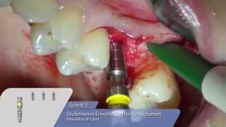 OT medical OTF3 ImplantatInsertion mit Sinuslift Osteotomie [upl. by Lezley]