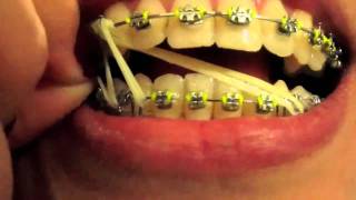 Braces Update  13 Eight Elastics [upl. by Coucher]