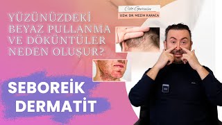 Seboreik Dermatit Ekzema nedir Tedavisi nasıl olmalı [upl. by Rosana]