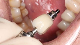 Full Contour Zirconia Implant Crown Insert [upl. by Bakerman]