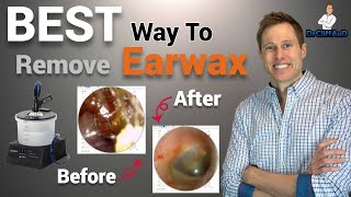 BEST Way to Clean Earwax From Your Ears  How to Use Qtips Correctly [upl. by Kirbee849]