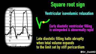 Constrictive pericarditis [upl. by Ahseenal]