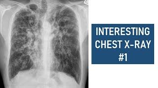 Interesting Chest Xray 1  Cystic Fibrosis [upl. by Oznol255]