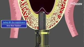 OSSTEM  HIOSSEN CASKit Crestal Approach Sinus Kit [upl. by Ykcub]