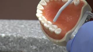 New cavity treatment offers no drilling no filling [upl. by Atiuqel]