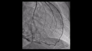 Constrictive Pericarditis [upl. by Jc]