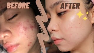 The best ANTI ACNE CREAM ✨  my holy grail  TRETINOIN [upl. by Duer]