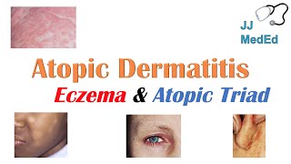 Eczema Atopic Dermatitis  Atopic Triad Triggers Who gets it Why does it happen amp Treatment [upl. by Vincentia]