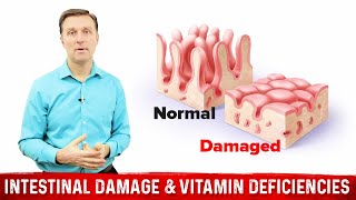 Intestinal Obstruction amp Vitamin Deficiencies – Dr Berg [upl. by Ramses834]