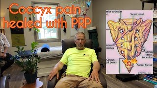 Coccyx pain healed with PRP [upl. by Epner]