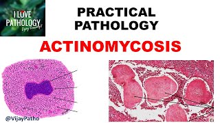 Practical Pathology ACTINOMYCOSIS [upl. by Walrath]