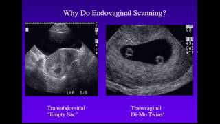 Sonography of Twins [upl. by Lilybelle]