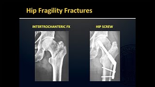 Fragility Fractures [upl. by Avuha]