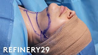 Reduce a Double Chin Without Surgery [upl. by Avner]