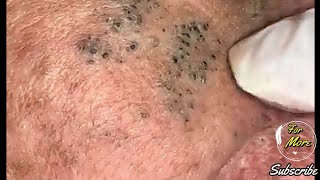 Dr Pop  Deep Blackheads in old Skin removing amp treatment 2020 Part 4 HD [upl. by Nessej586]