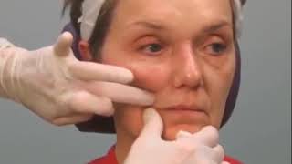 Lifting Mouth Corners amp Filling Marionette Lines With Dermal Filler [upl. by Sivel263]