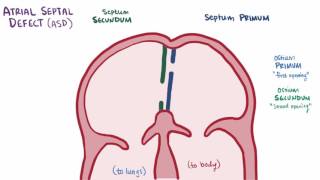 Atrial septal defect ASD repair causes types symptoms amp pathology [upl. by Euphemie]