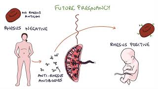 Understanding Rhesus Status and AntiD in Pregnancy [upl. by Ecilayram393]