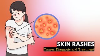 Skin Rash Causes Signs and Symptoms Diagnosis and Treatment [upl. by Puritan]