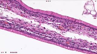 Histopathology OvarySerous cystadenoma [upl. by Loos284]