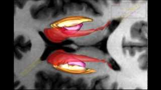 3D Brain from MRI 5 Lentiform nucleus and internal capsule [upl. by Frank]