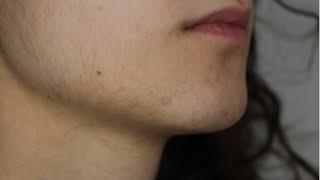 UPDATE 1 FACIAL HAIR ELECTROLYSIS VS LASER HAIR REMOVAL  PCOS [upl. by Lilaj629]