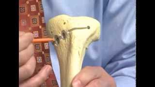 Osteoid Osteoma Bone Pathology Basics [upl. by Anoyk]