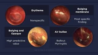 Acute Otitis Media Otoscopic Findings [upl. by Burny]