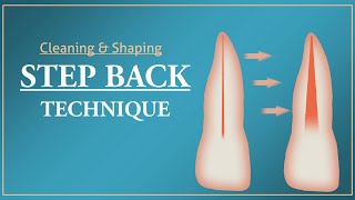 Step Back Technique  Root Canal Treatment [upl. by Humble]