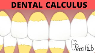 Dental Calculus Part 1 ‖ Dental Calculus Made Easy ‖ Perio Hub ‖ Dr Sneha [upl. by Butch]