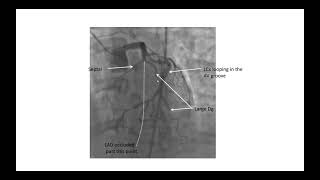 Coronary angiographic views Elias Hanna [upl. by Branen656]