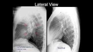 Chest Xray Cases 2 [upl. by Niahs]