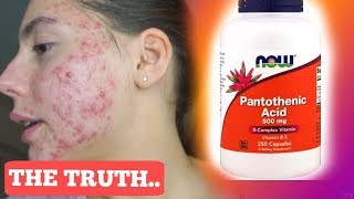 I TOOK PANTOTHENIC ACID FOR ONE MONTH STRAIGHT  THIS IS WHAT ACTUALLY HAPPENED TO MY ACNE [upl. by Rebmak]