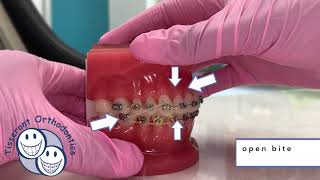 Elastics in Orthodontics  Class 2 Triangle Elastics [upl. by Bruns]