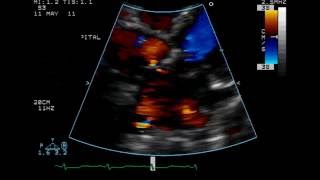 Atrial Septal Defect  Ostium Secundum Type  TTE [upl. by Brockwell89]